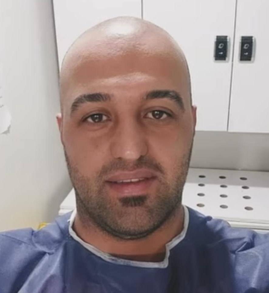 ورم بعد کاشت مو میکرواسکالپ