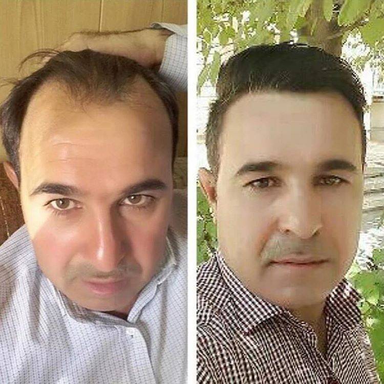 تاثیر هورمون ها بر رشد و ریزش مو کاشت مو با بانک موی ضعیف کاشت مو
