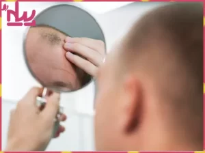 تاثیر هورمون ها بر رشد و ریزش مو چگونه است ؟