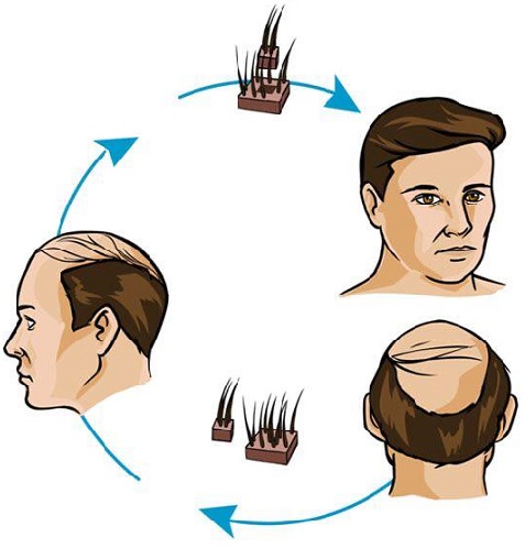 رشد مو بعد از کاشت مو