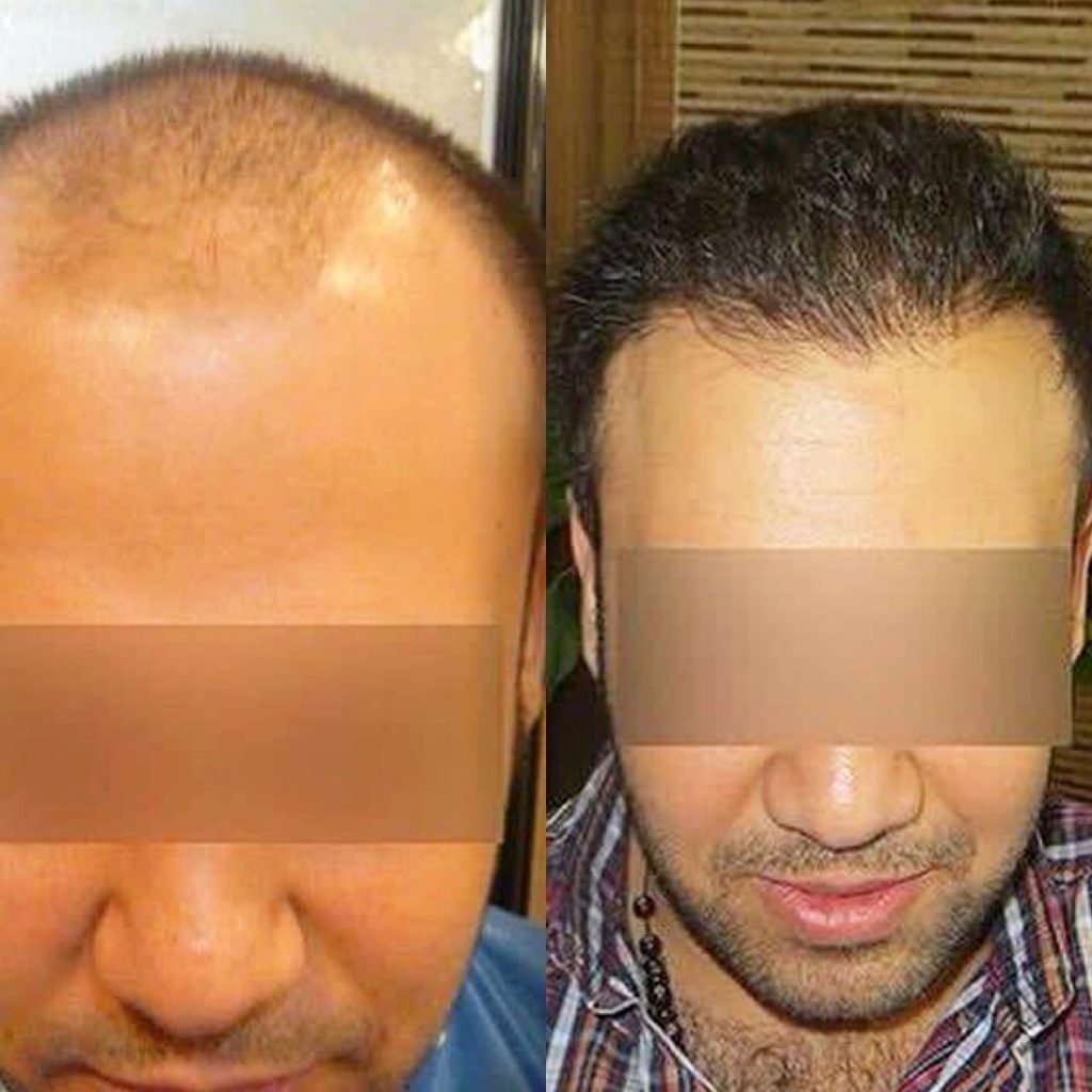 ریزش مو بر اثر استرس کاشت مو با بانک موی فرد دیگر