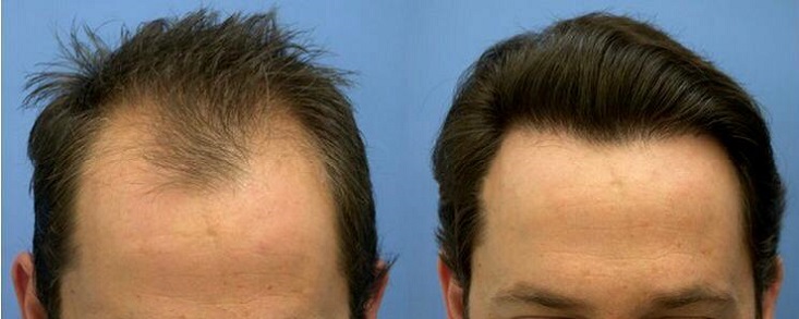 مراقبت های لازم قبل و بعد از کاشت مو