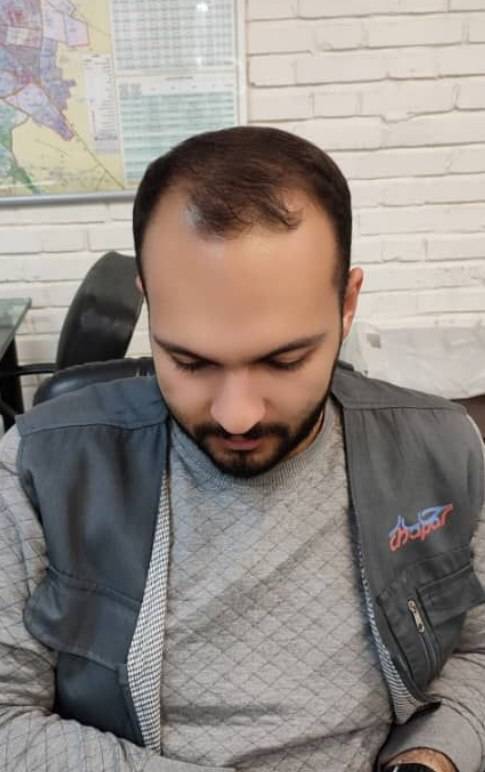 خوابیدن پس از کاشت مو