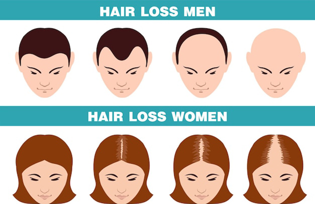 ریزش موی ژنتیکی یا ارثی
