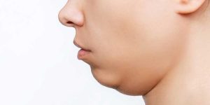 بوتاکس چانه و غبغب چیست