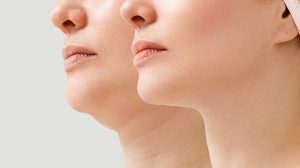 لیفت غبغب با نخ یا هایفوتراپی؟ بهترین روش کدام است؟