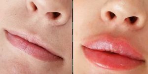 پروتز لب | همه چیز درباره روش‌ها، مزایا و مراقبت‌ها