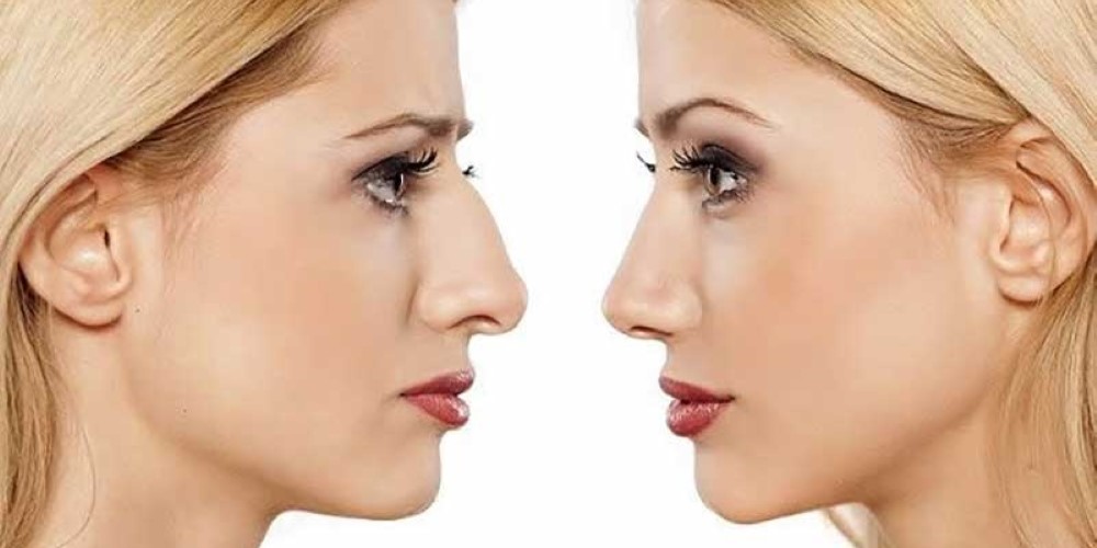 رینوپلاستی چیست؟