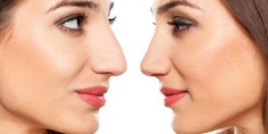رینوپلاستی؛ آنچه باید درباره جراحی زیبایی بینی بدانید